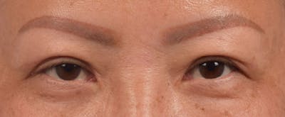 Hidden Patients Before & After Gallery - Patient 127674 - Image 2