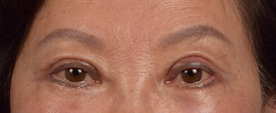 Hidden Patients Before & After Gallery - Patient 145659 - Image 2