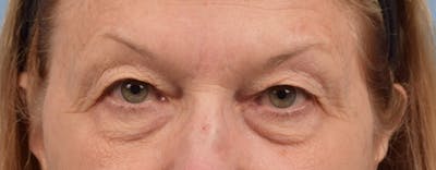 Hidden Patients Before & After Gallery - Patient 288598 - Image 1