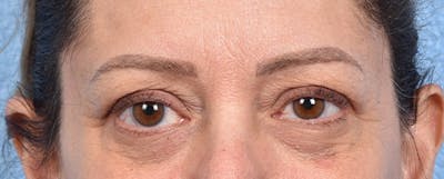 Hidden Patients Before & After Gallery - Patient 270778 - Image 1