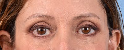 Hidden Patients Before & After Gallery - Patient 270778 - Image 2