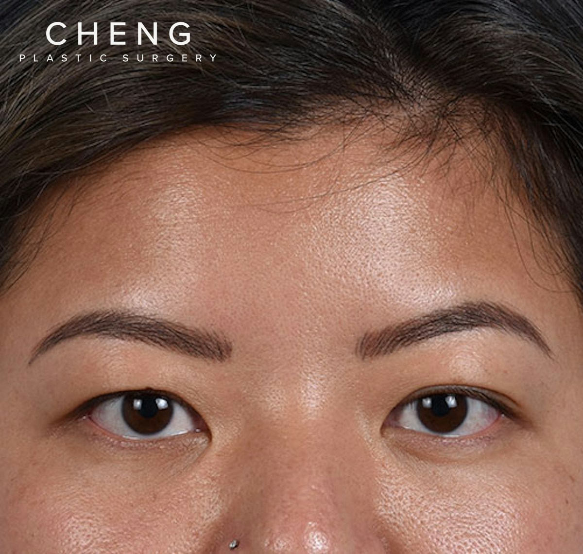 Hidden Patients Before & After Gallery - Patient 392040 - Image 1
