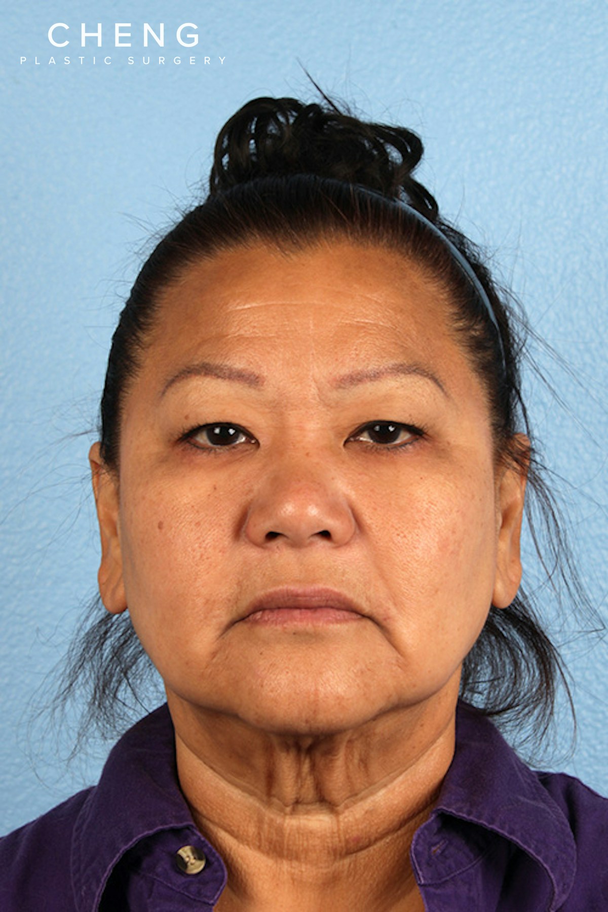 Hidden Patients Before & After Gallery - Patient 273819 - Image 1