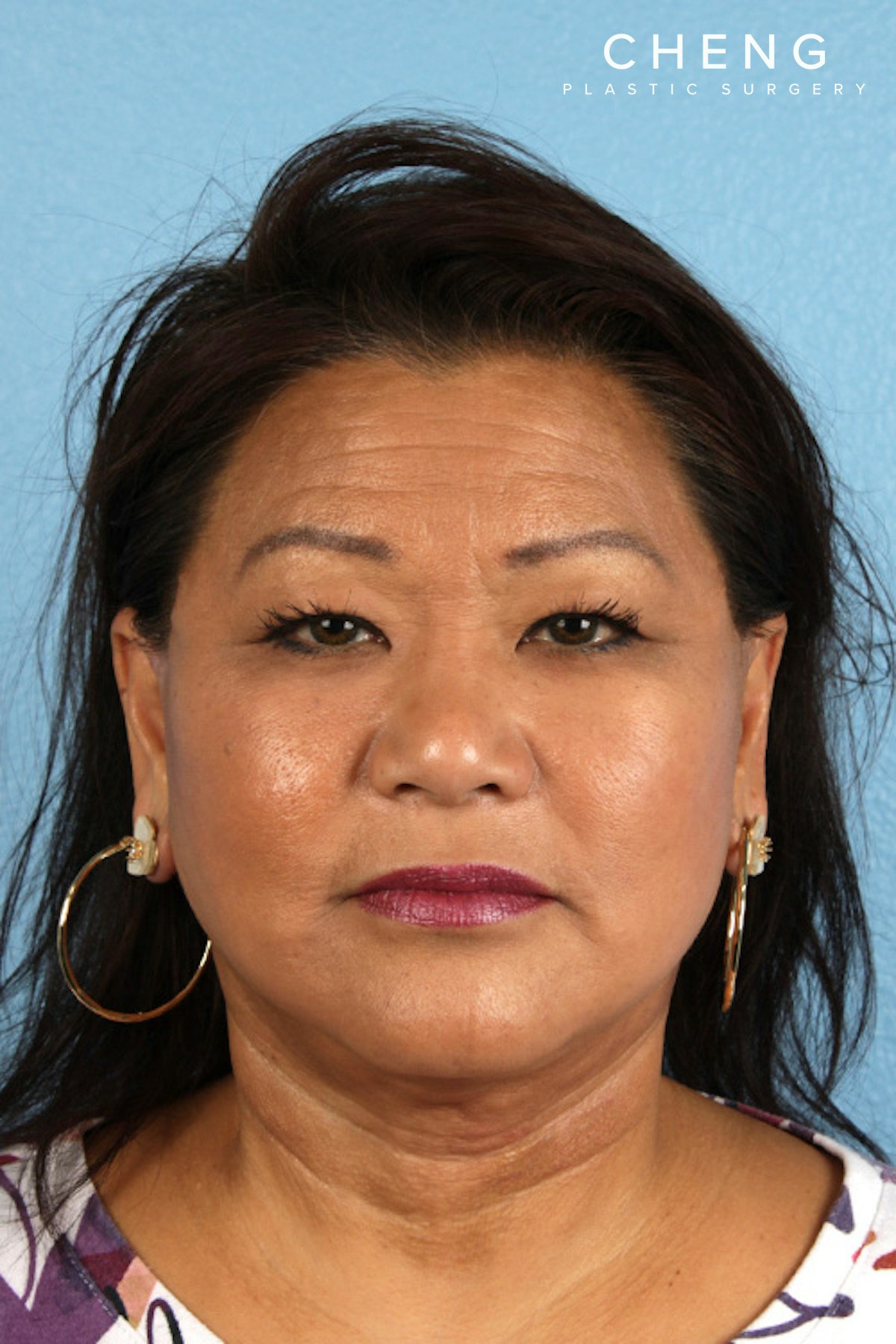 Hidden Patients Before & After Gallery - Patient 273819 - Image 2