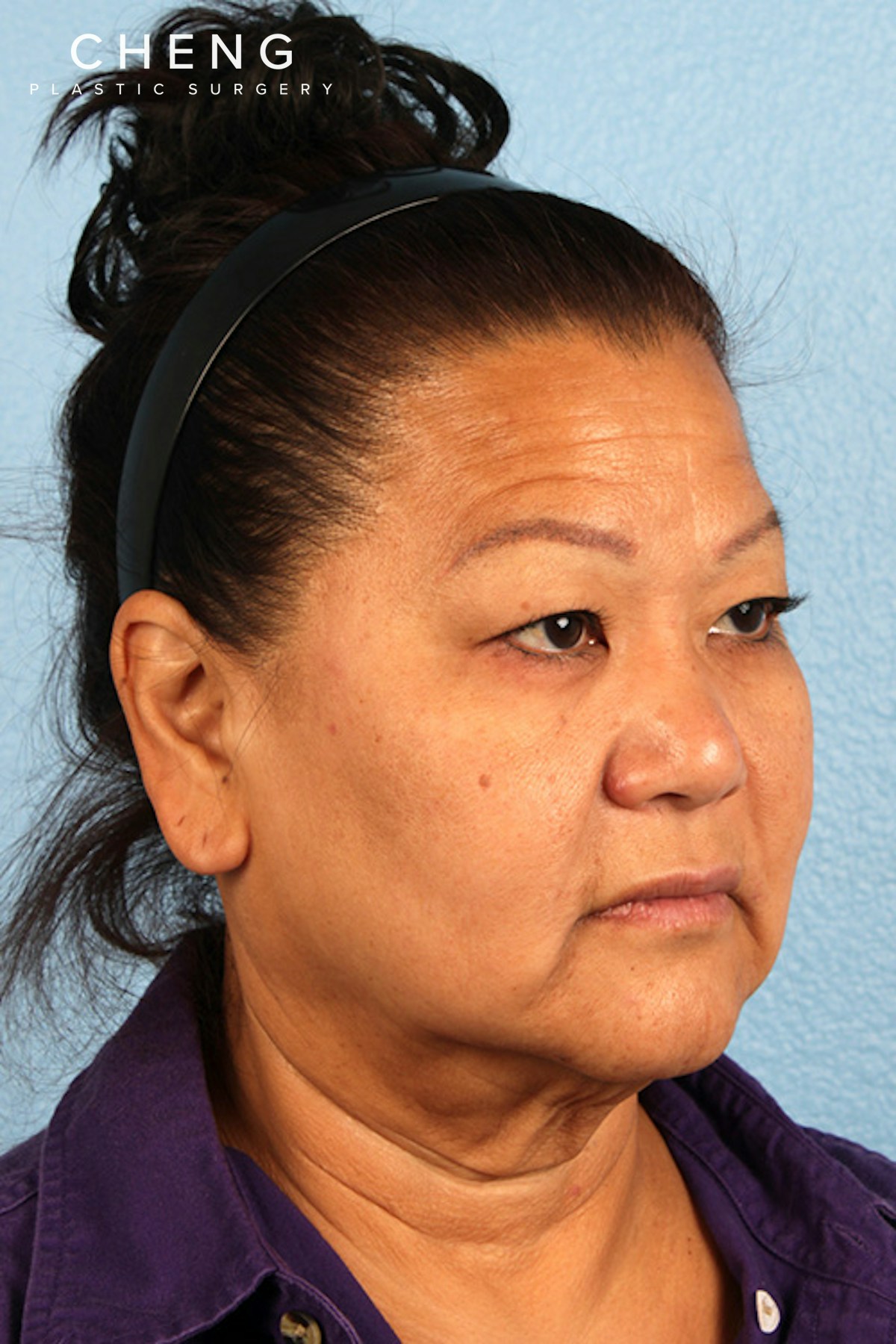 Hidden Patients Before & After Gallery - Patient 273819 - Image 3