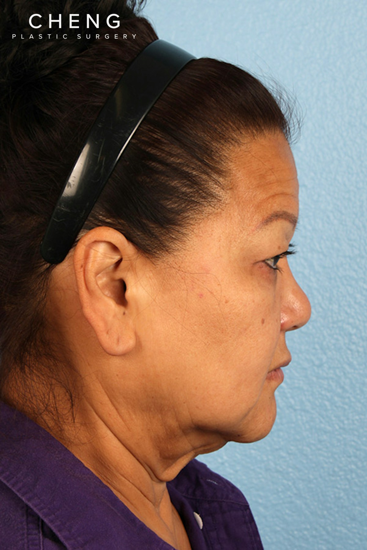 Hidden Patients Before & After Gallery - Patient 273819 - Image 5