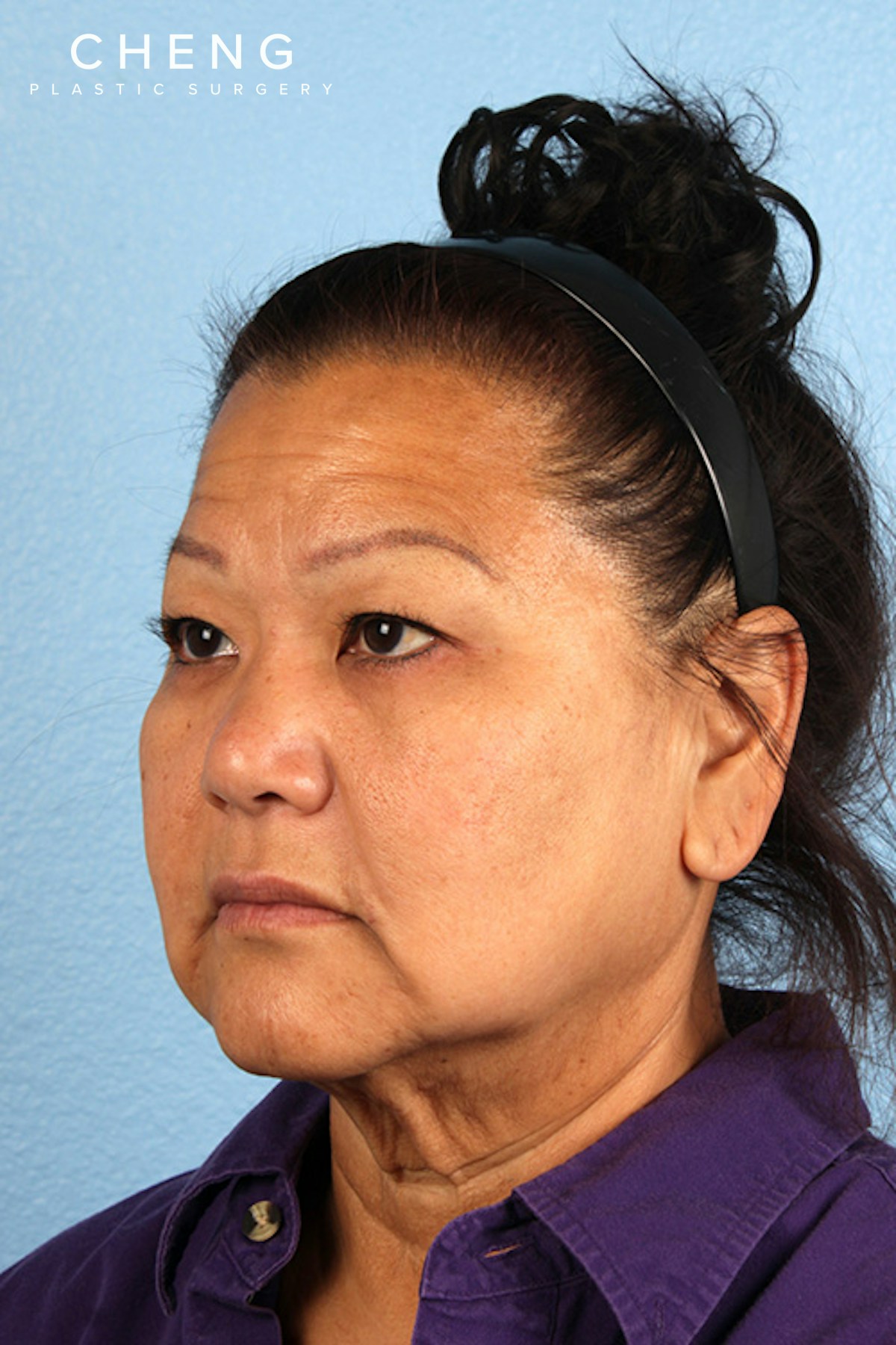 Hidden Patients Before & After Gallery - Patient 273819 - Image 7