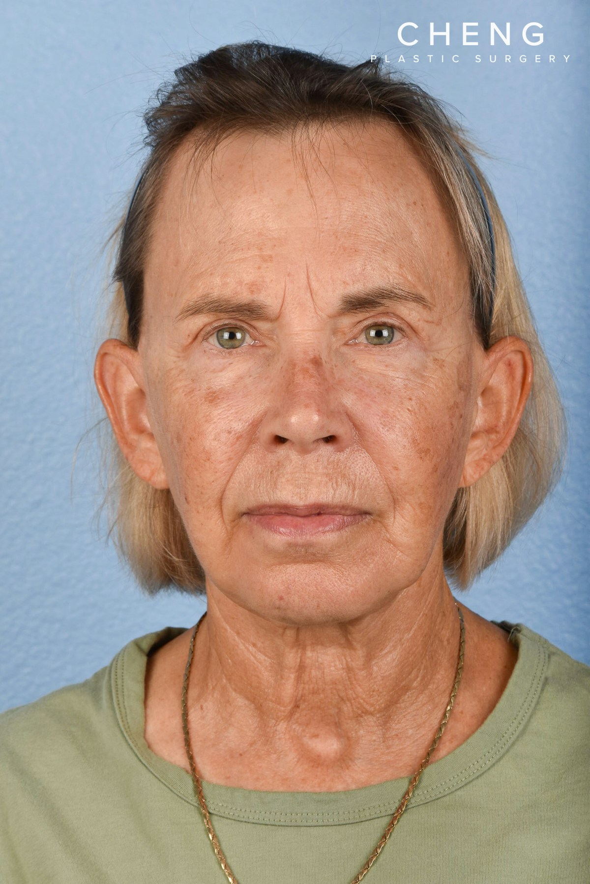 Hidden Patients Before & After Gallery - Patient 616456 - Image 2