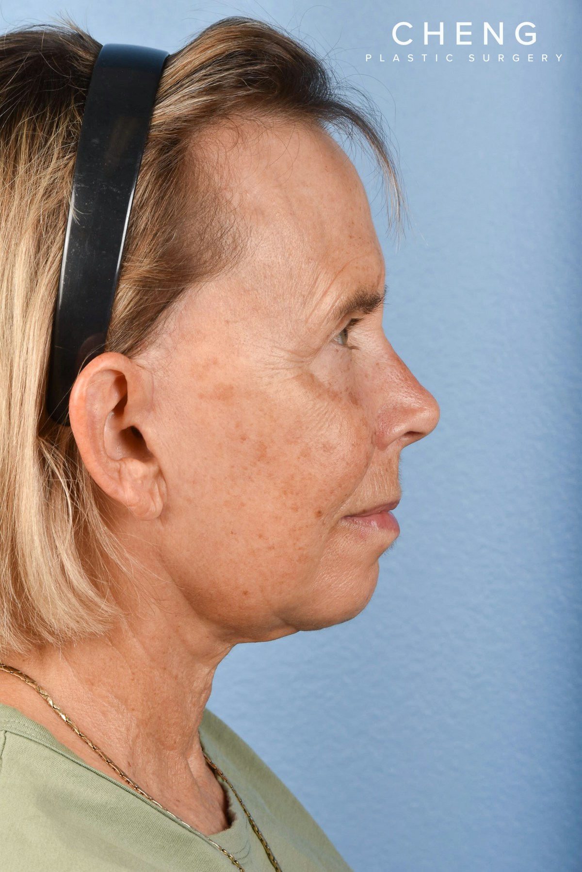 Hidden Patients Before & After Gallery - Patient 616456 - Image 10