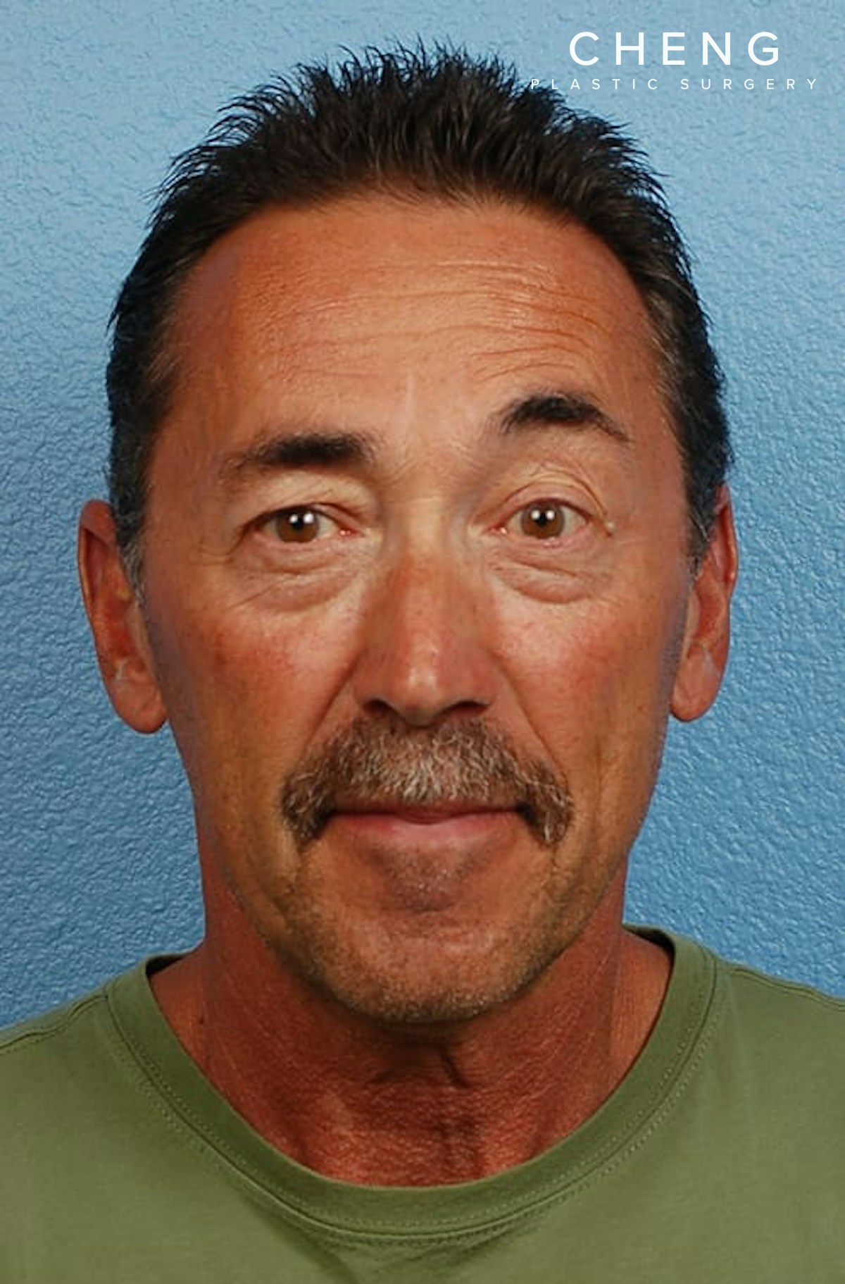 Hidden Patients Before & After Gallery - Patient 357550 - Image 2