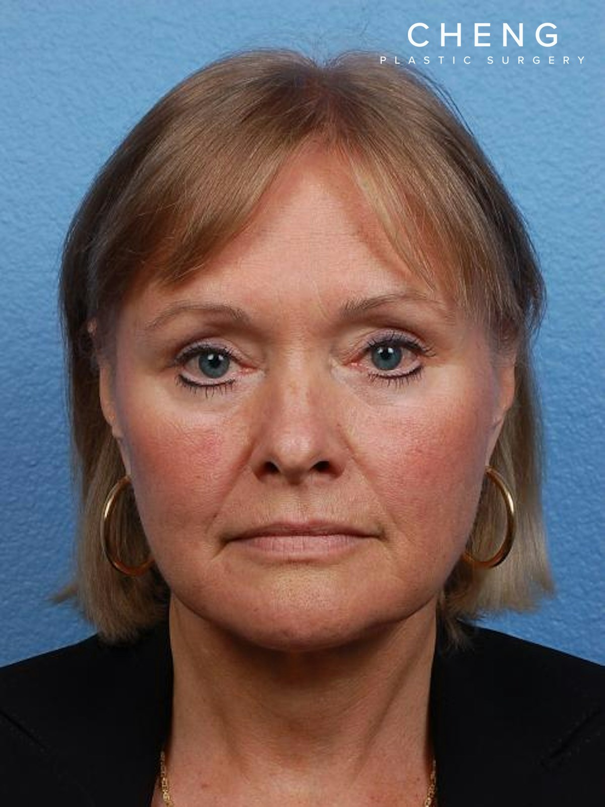 Hidden Patients Before & After Gallery - Patient 176103 - Image 2