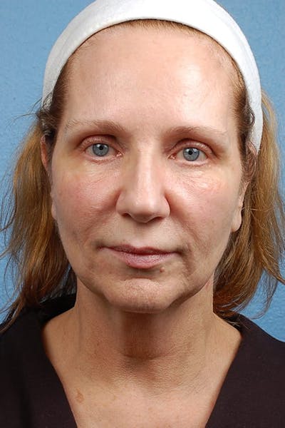 Hidden Patients Before & After Gallery - Patient 659782 - Image 1