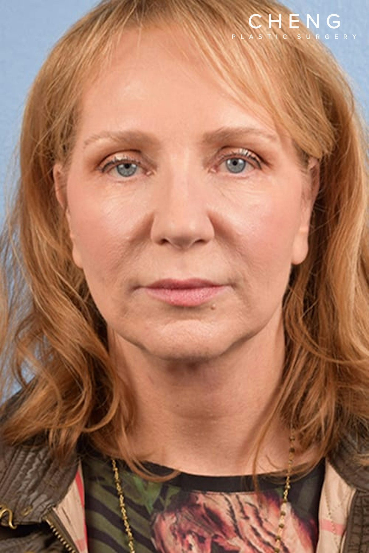 Hidden Patients Before & After Gallery - Patient 659782 - Image 2