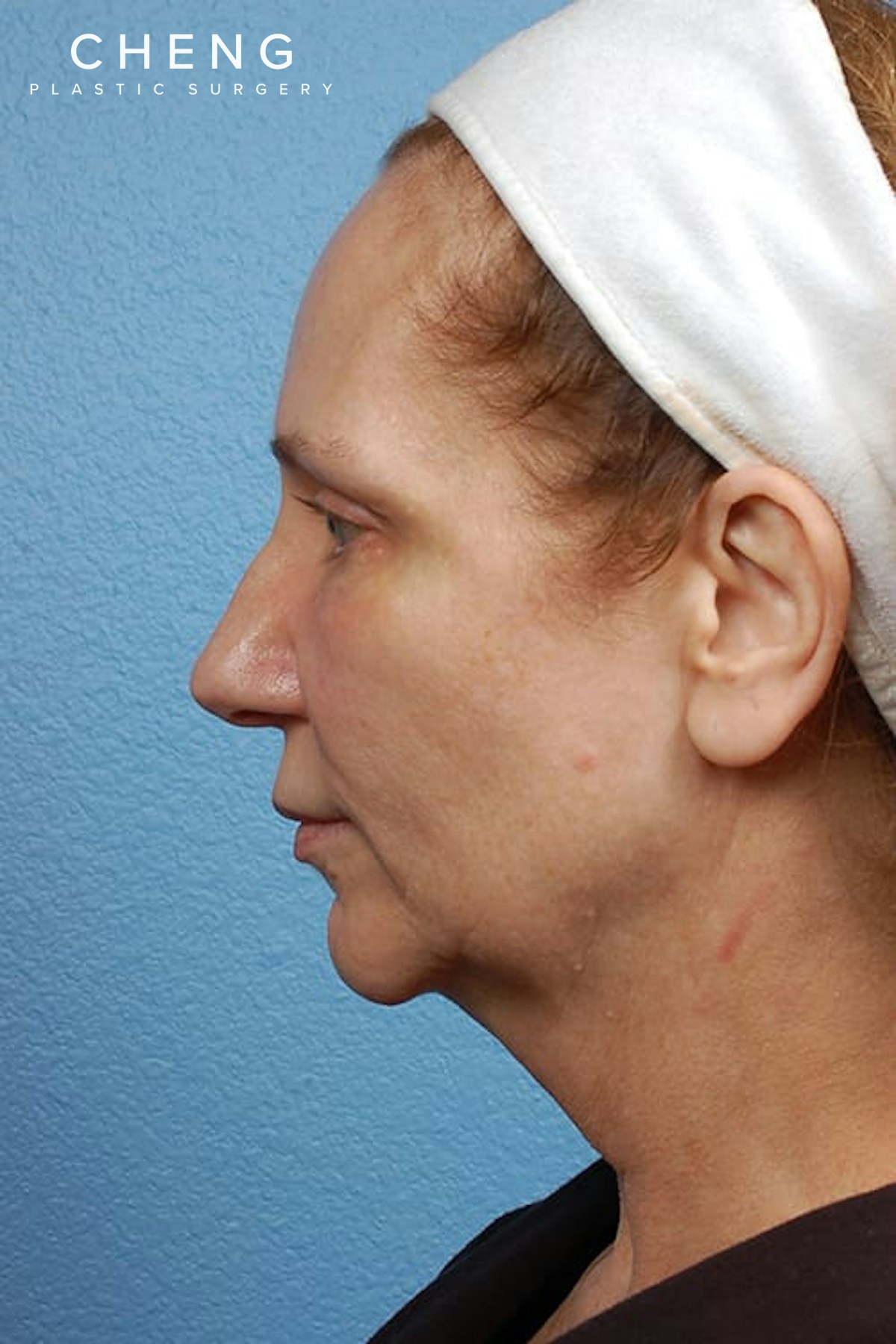 Hidden Patients Before & After Gallery - Patient 659782 - Image 3