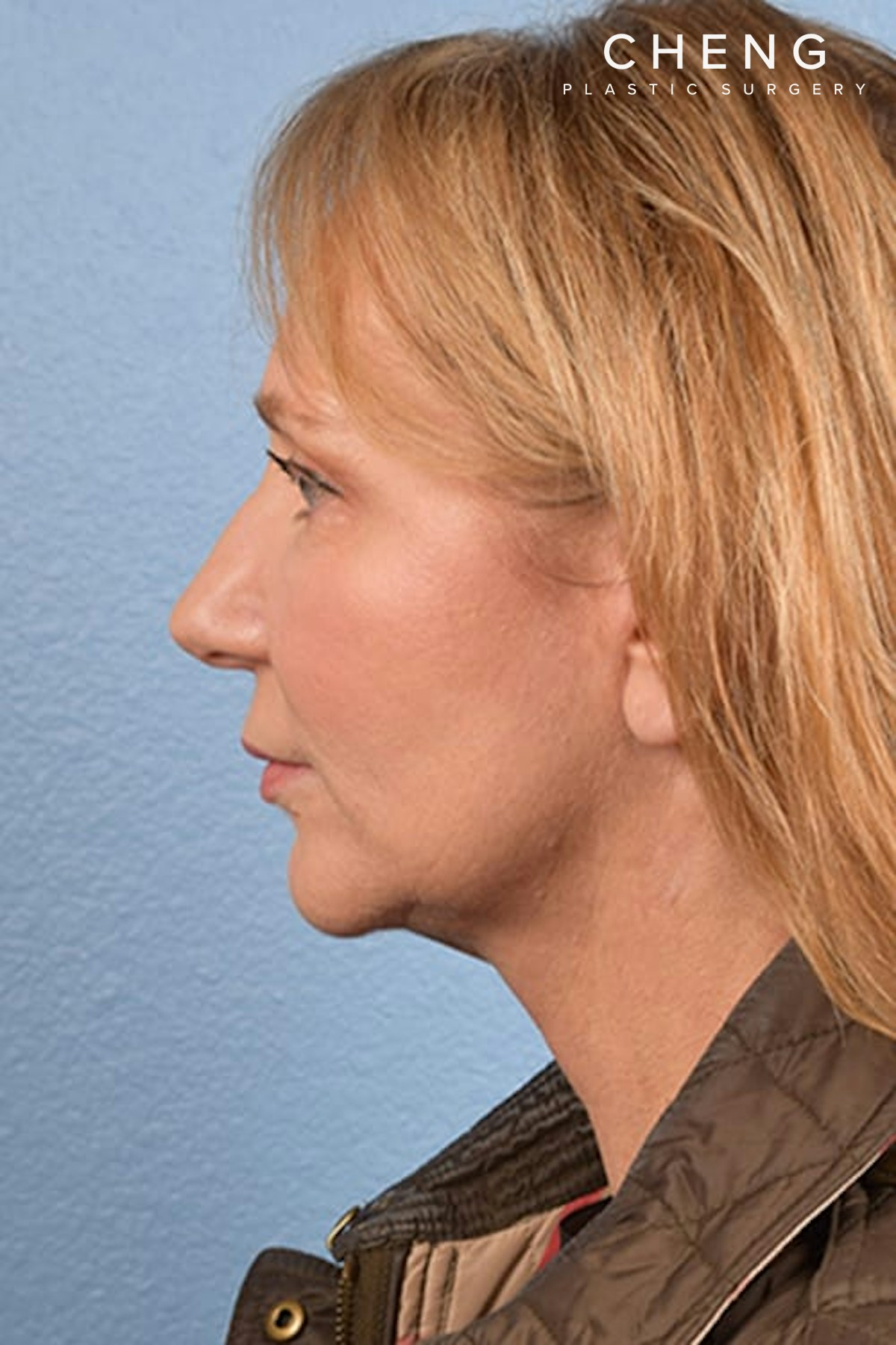 Hidden Patients Before & After Gallery - Patient 659782 - Image 4