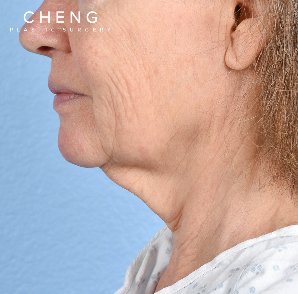 Hidden Patients Before & After Gallery - Patient 222540 - Image 1