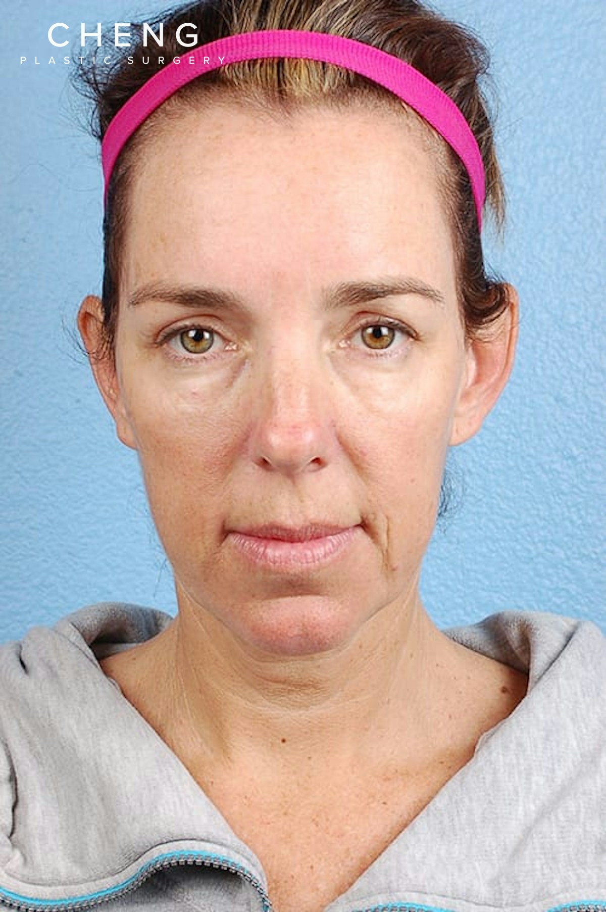 Hidden Patients Before & After Gallery - Patient 470748 - Image 1