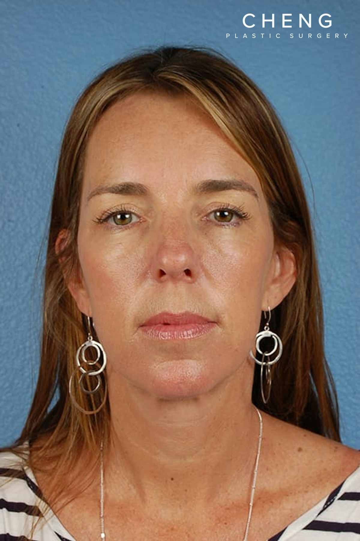 Hidden Patients Before & After Gallery - Patient 470748 - Image 2