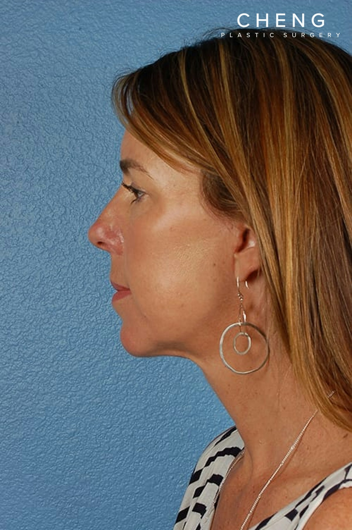 Hidden Patients Before & After Gallery - Patient 470748 - Image 4