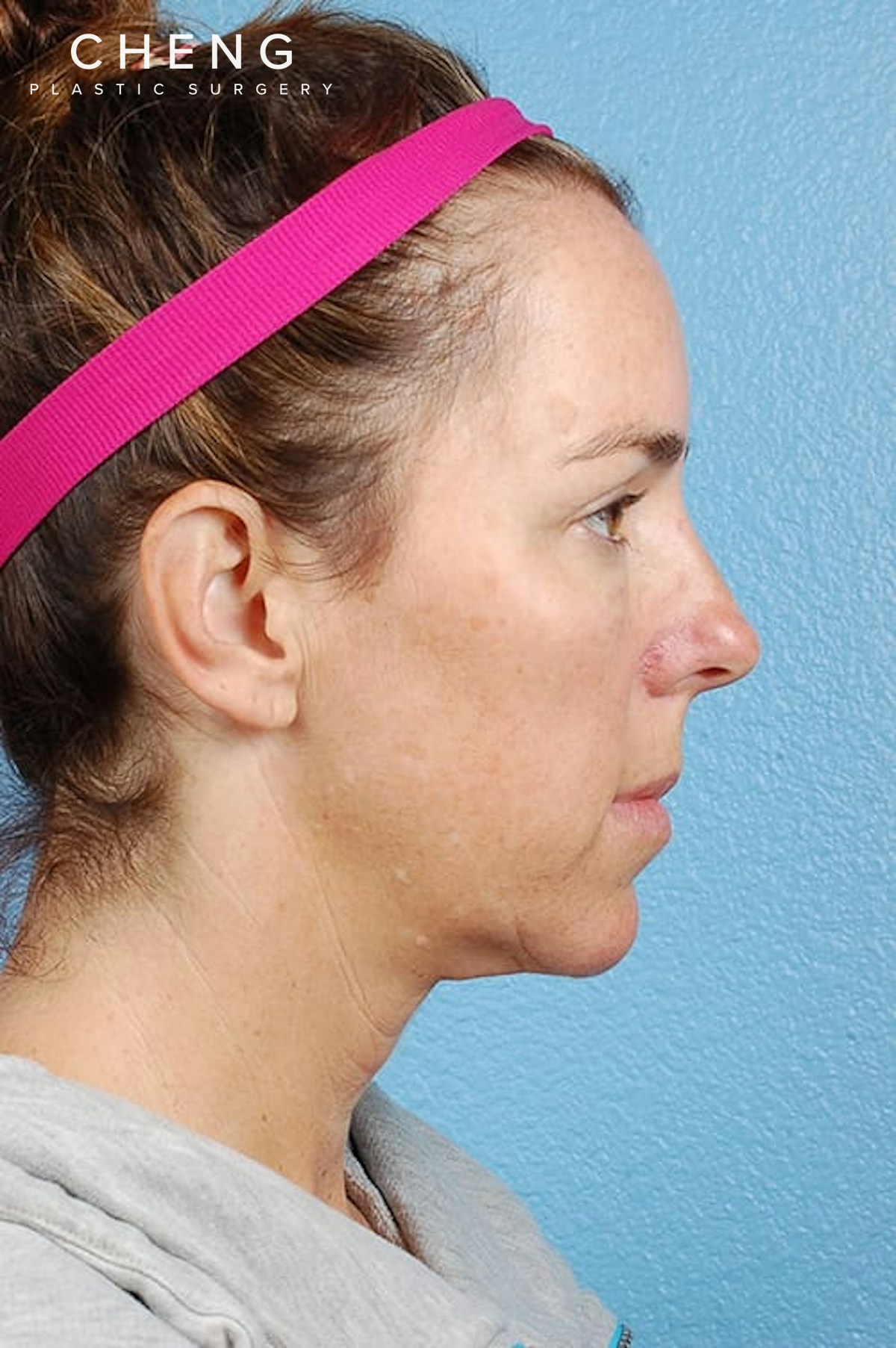 Hidden Patients Before & After Gallery - Patient 470748 - Image 5