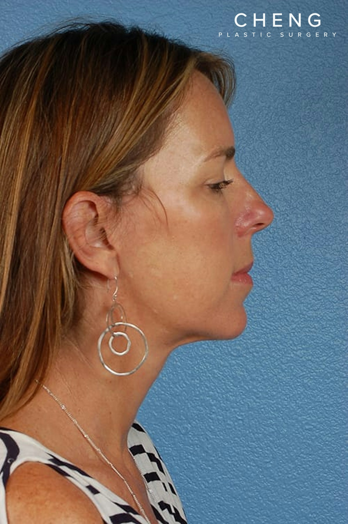 Hidden Patients Before & After Gallery - Patient 470748 - Image 6
