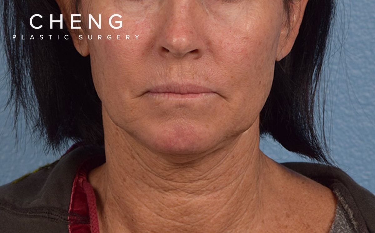 Hidden Patients Before & After Gallery - Patient 372705 - Image 1