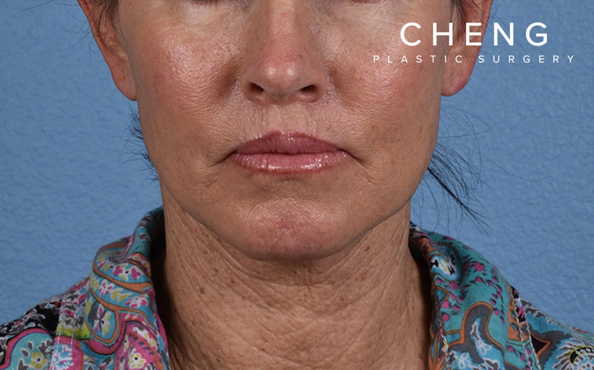 Hidden Patients Before & After Gallery - Patient 372705 - Image 2