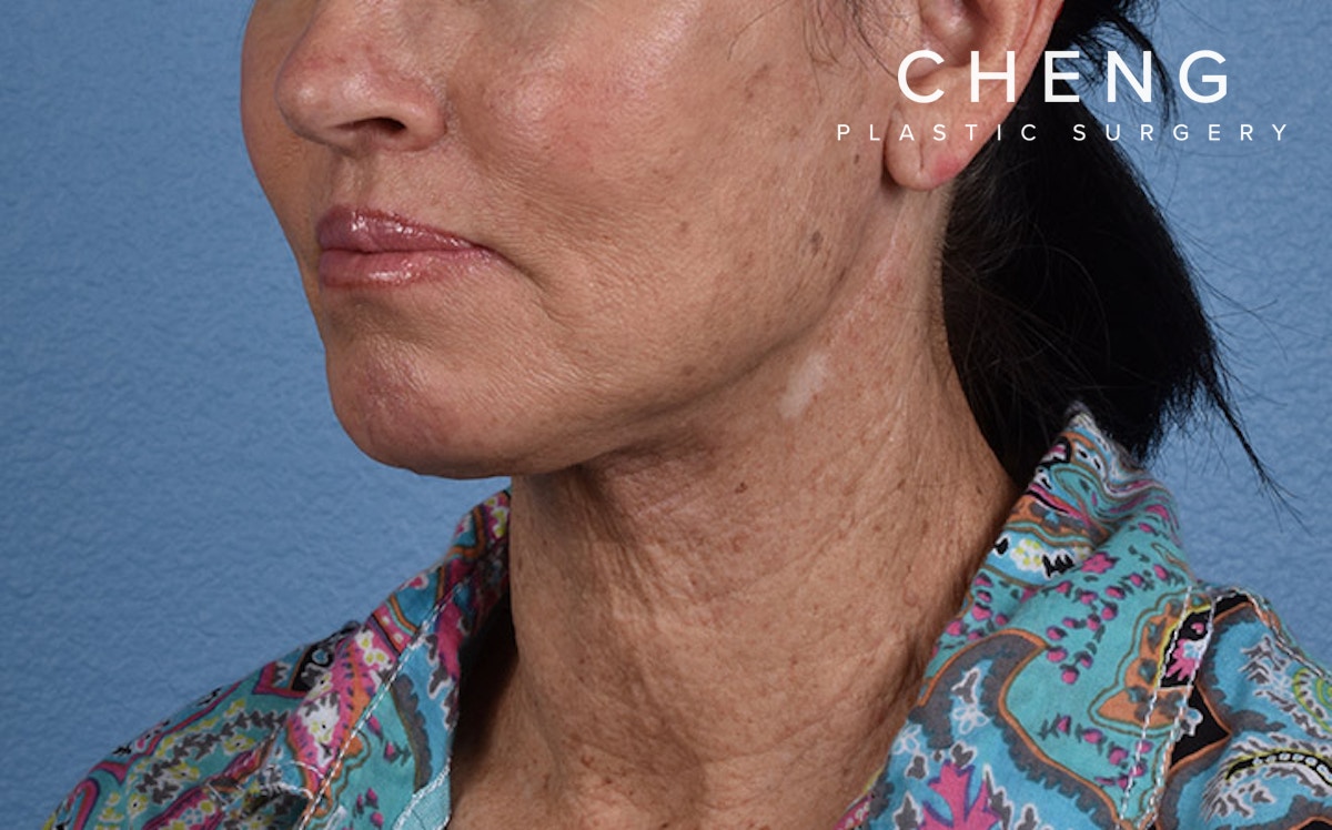 Hidden Patients Before & After Gallery - Patient 372705 - Image 4