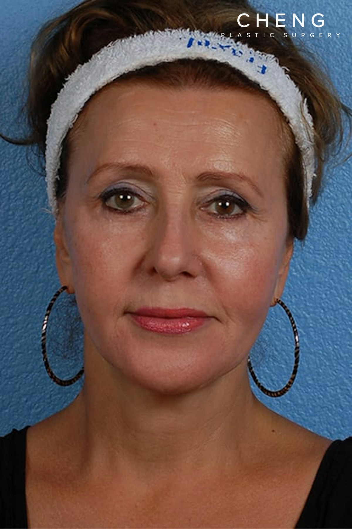 Hidden Patients Before & After Gallery - Patient 418015 - Image 2