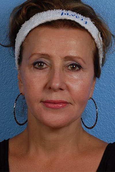 Hidden Patients Before & After Gallery - Patient 418015 - Image 2