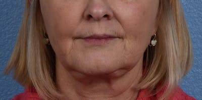 Hidden Patients Before & After Gallery - Patient 186097 - Image 2