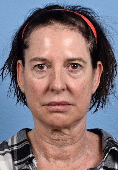 Hidden Patients Before & After Gallery - Patient 310808 - Image 1