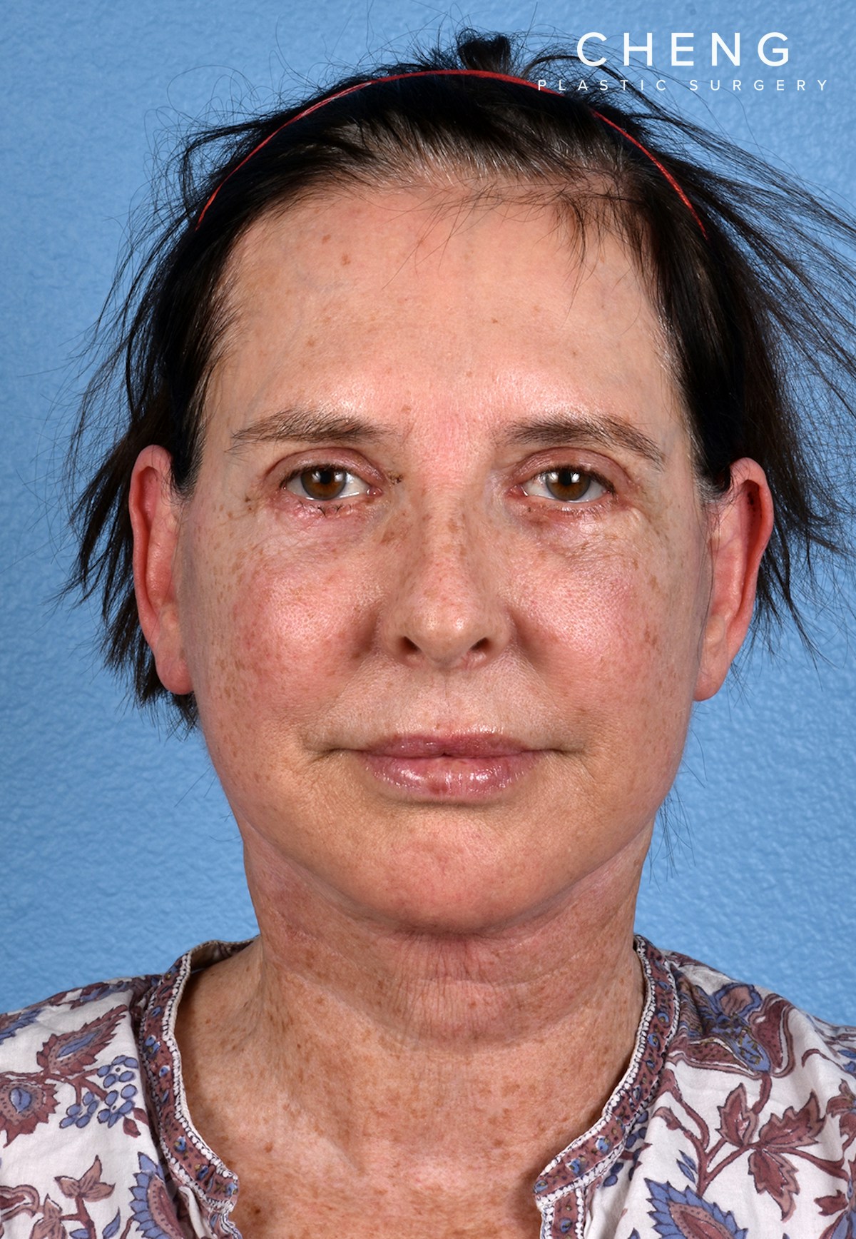 Hidden Patients Before & After Gallery - Patient 310808 - Image 2