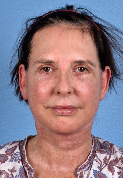 Hidden Patients Before & After Gallery - Patient 310808 - Image 2