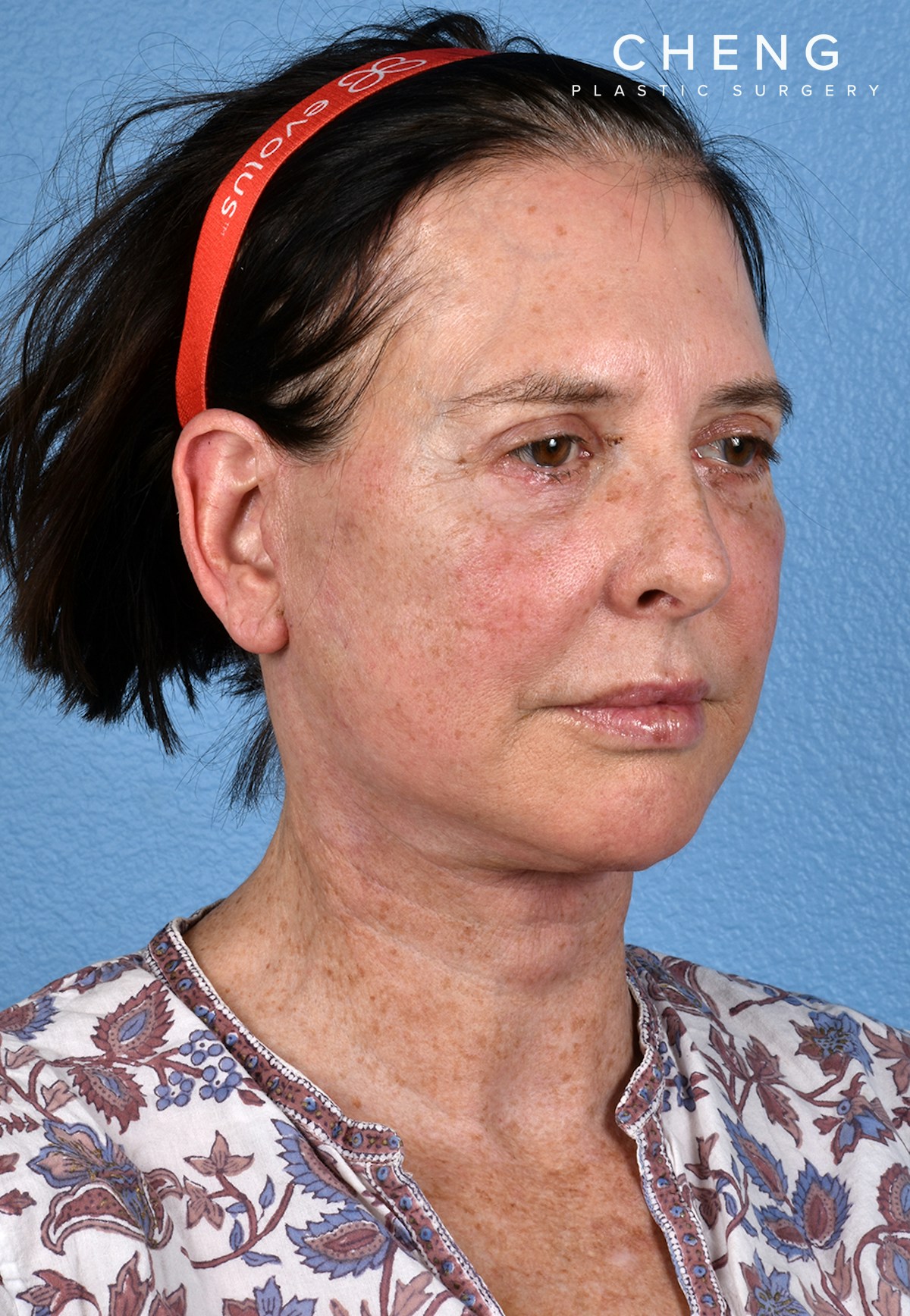 Hidden Patients Before & After Gallery - Patient 310808 - Image 4