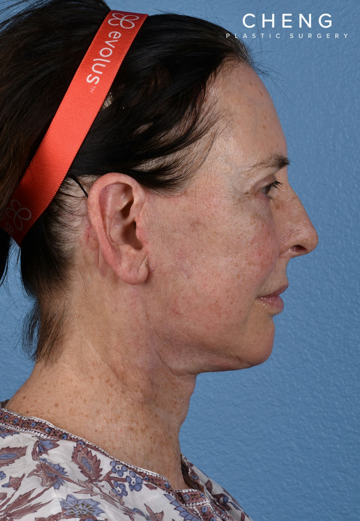 Hidden Patients Before & After Gallery - Patient 310808 - Image 6
