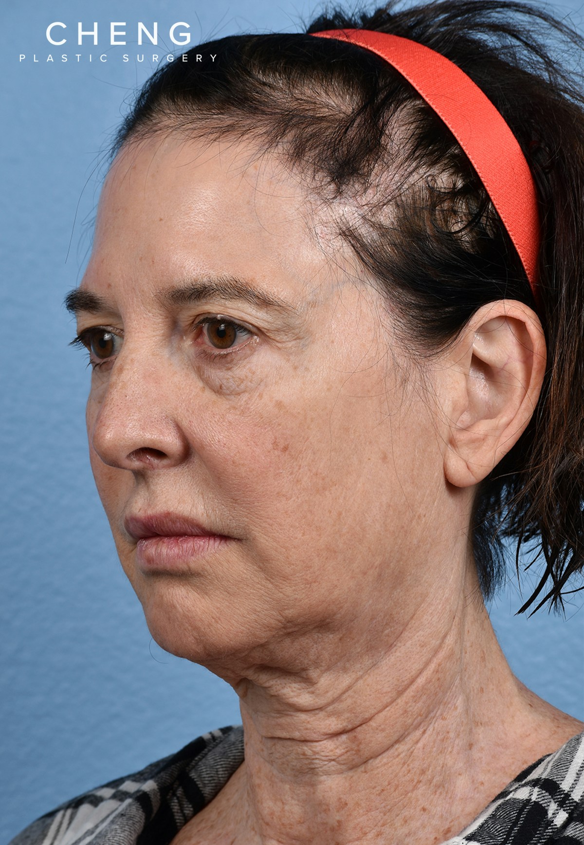 Hidden Patients Before & After Gallery - Patient 310808 - Image 7