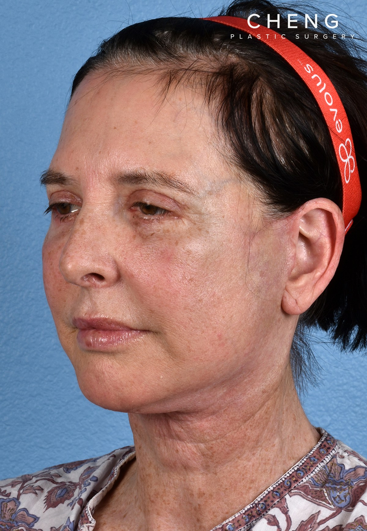 Hidden Patients Before & After Gallery - Patient 310808 - Image 8