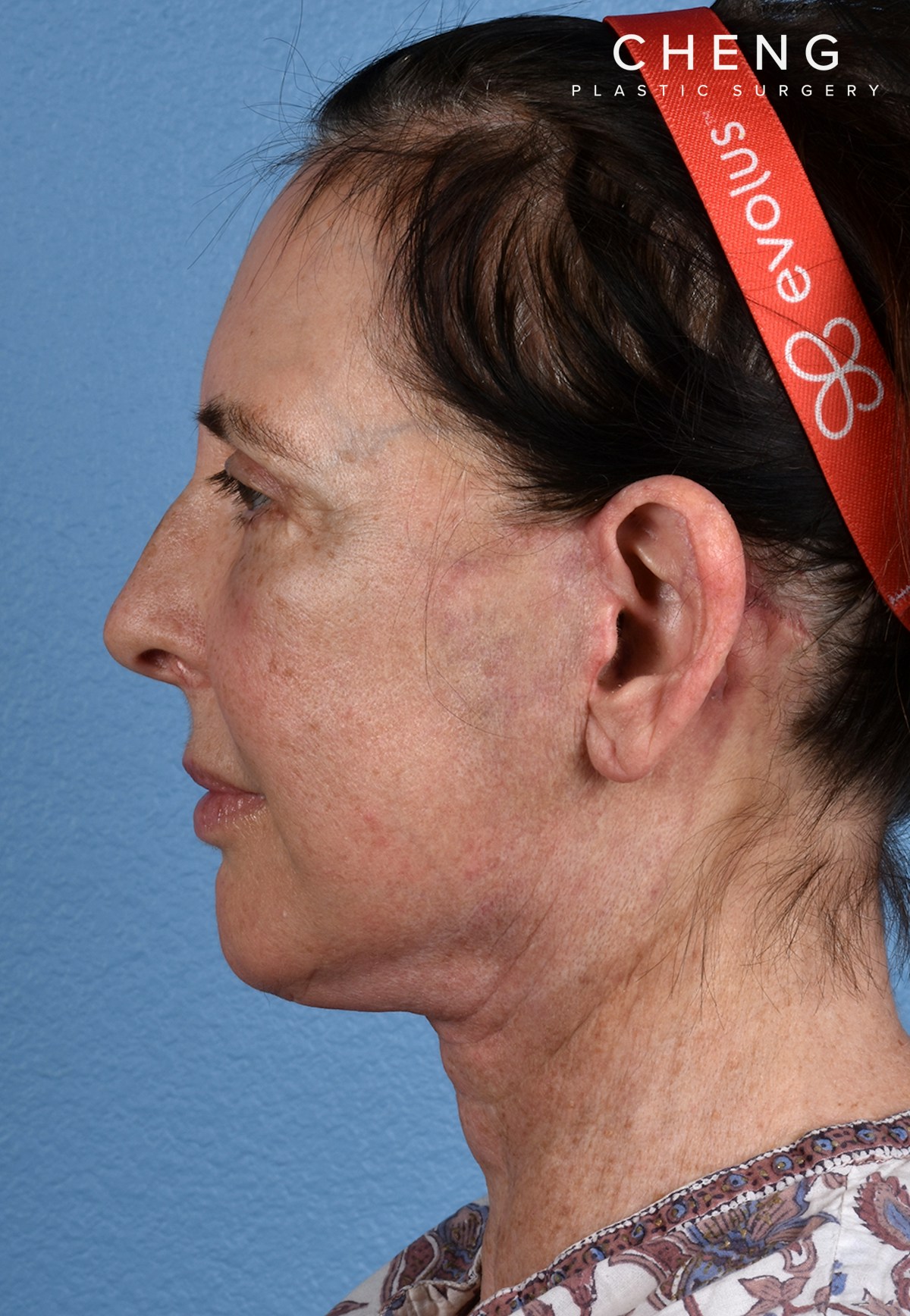 Hidden Patients Before & After Gallery - Patient 310808 - Image 10