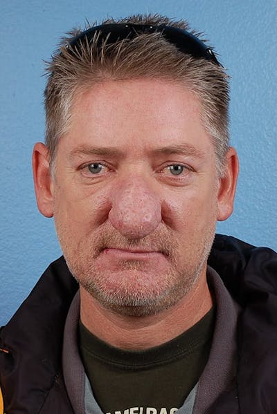 Hidden Patients Before & After Gallery - Patient 532992 - Image 1