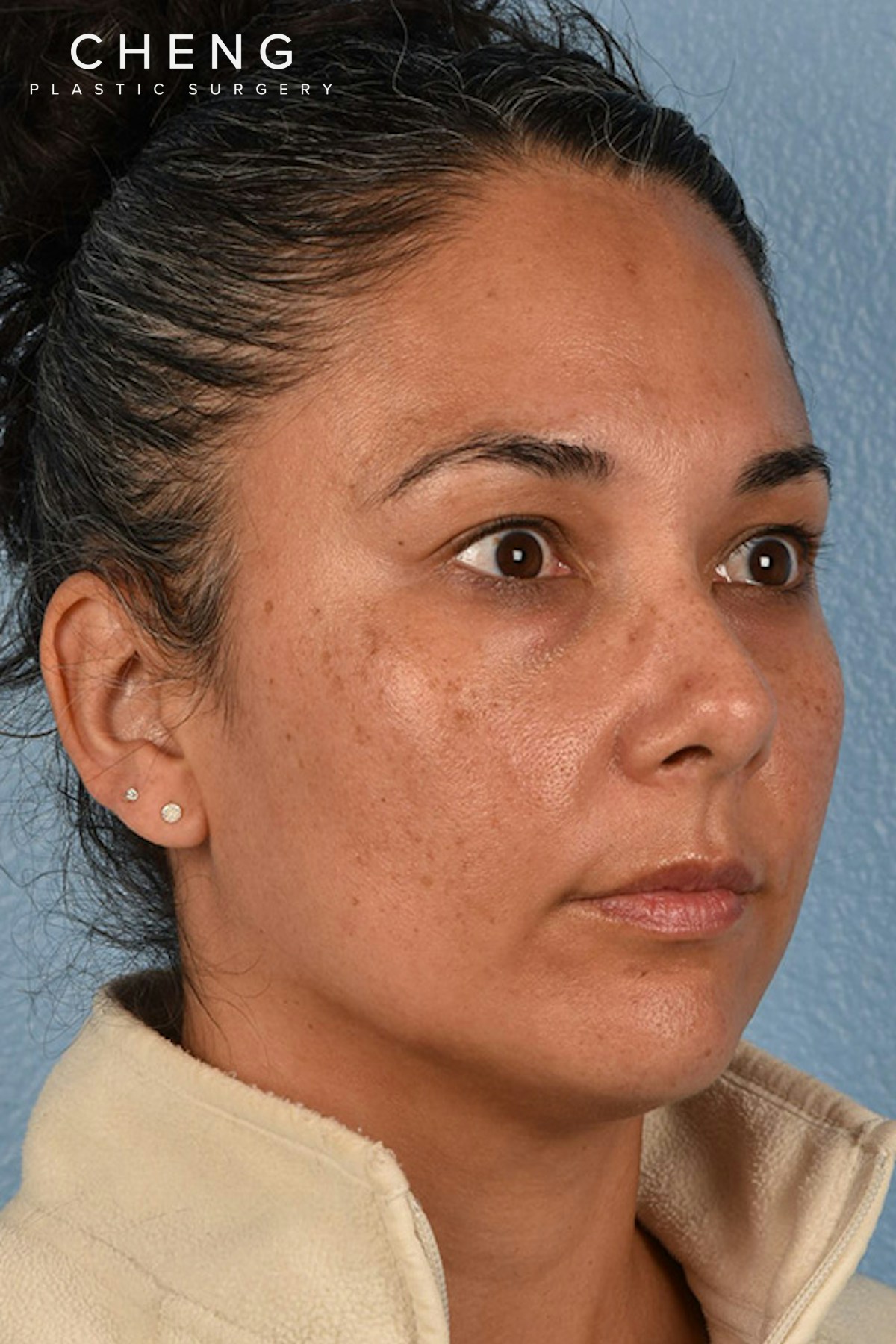Hidden Patients Before & After Gallery - Patient 162458 - Image 1