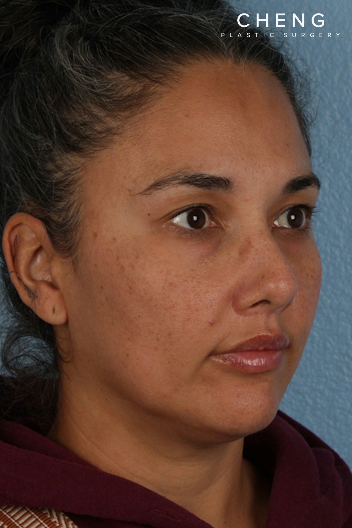 Hidden Patients Before & After Gallery - Patient 162458 - Image 2