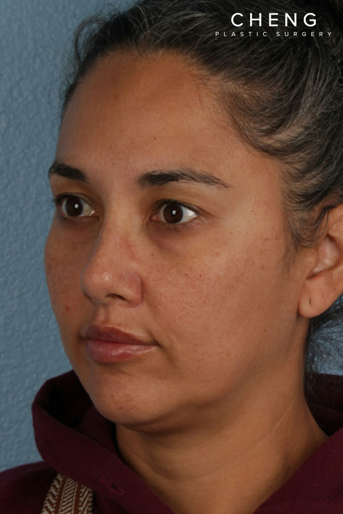 Hidden Patients Before & After Gallery - Patient 162458 - Image 4