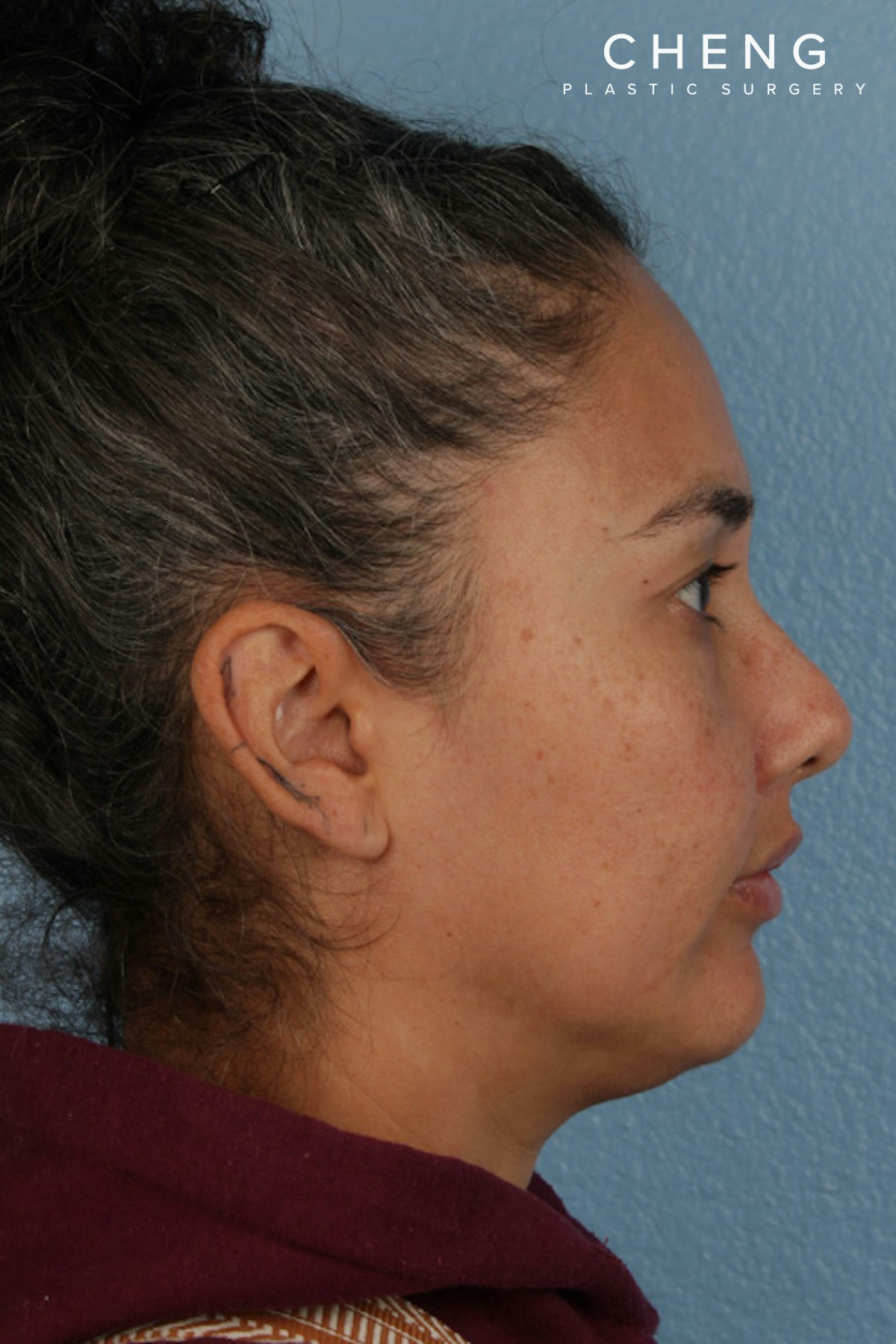 Hidden Patients Before & After Gallery - Patient 162458 - Image 6