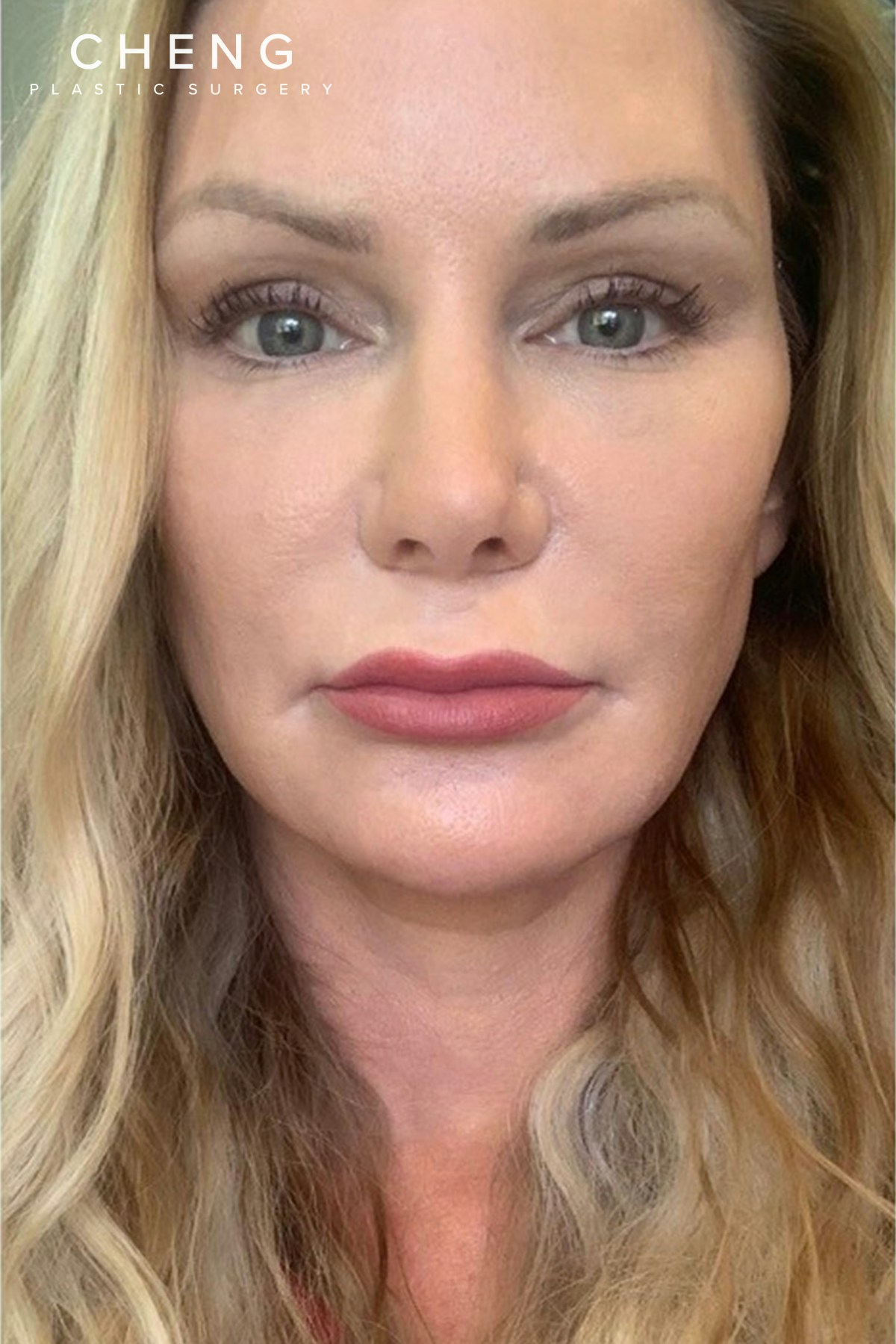 Hidden Patients Before & After Gallery - Patient 357343 - Image 1