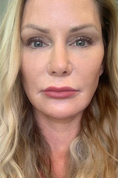 Hidden Patients Before & After Gallery - Patient 402708 - Image 1