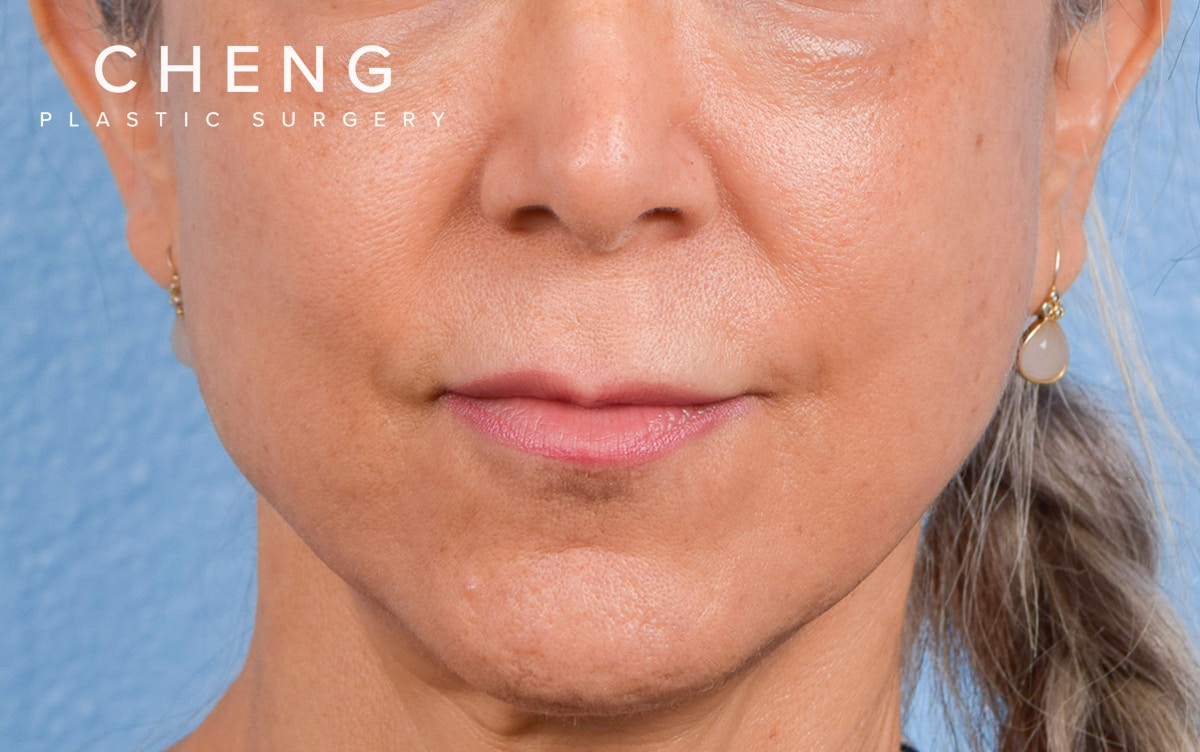 Hidden Patients Before & After Gallery - Patient 372181 - Image 1