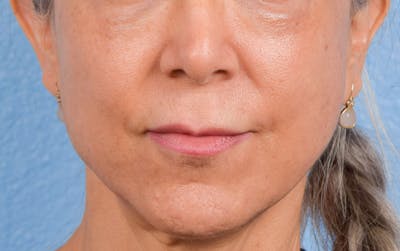 Hidden Patients Before & After Gallery - Patient 372181 - Image 1