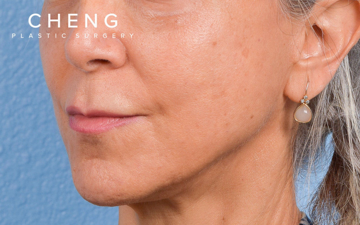 Hidden Patients Before & After Gallery - Patient 372181 - Image 3