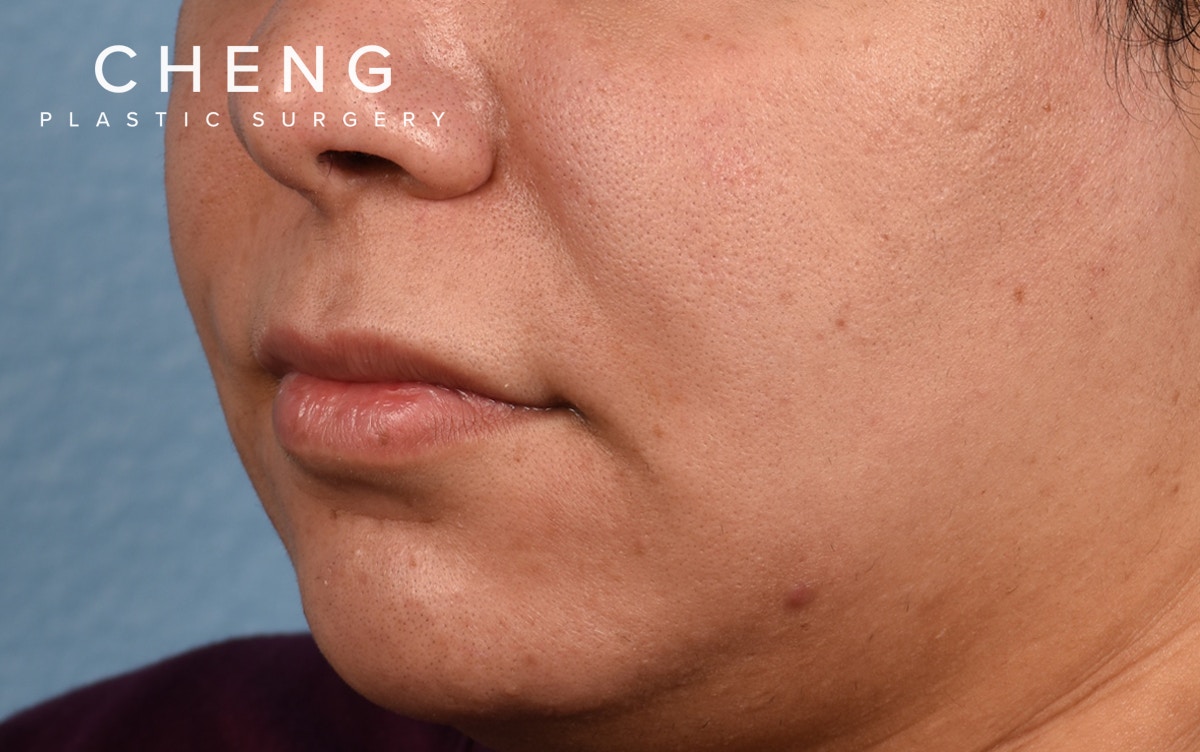 Hidden Patients Before & After Gallery - Patient 279952 - Image 5
